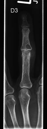 Riesenzelltumor Osteoklastom Des Handskeletts Springerlink