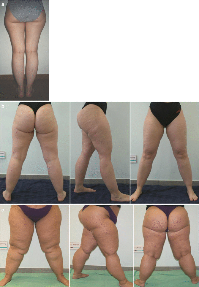 cellulite dolorosa