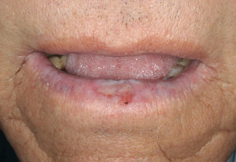 Erkrankungen der Lippen und der Mundhöhle SpringerLink