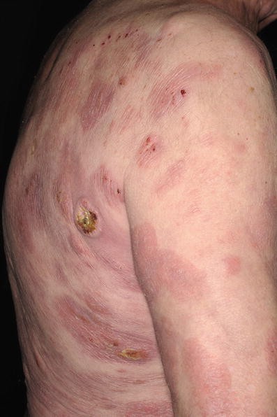 27+ Lymphomatoide Papulose Lymphknoten Pics