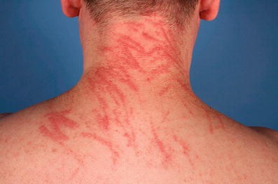 Toxische und allergische Kontaktdermatitis | SpringerLink
