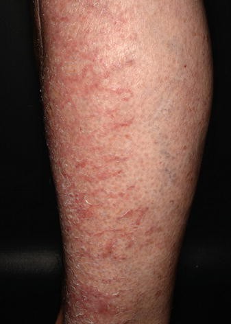 Toxische und allergische Kontaktdermatitis | SpringerLink