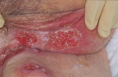 Behandlung herpes genitalis mann