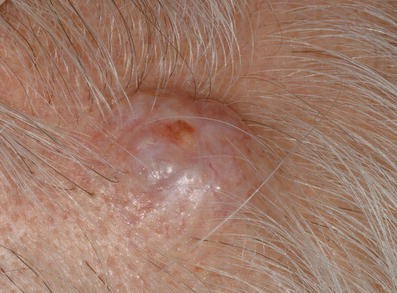 Zysten Und Pseudozysten Der Haut Springerlink Zysten Und Pseudozysten Der Haut Springerlink