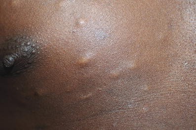 Zysten Und Pseudozysten Der Haut Springerlink Zysten Und Pseudozysten Der Haut Springerlink