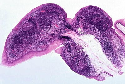 Hpv and gallbladder - Papiloma palpebral cid