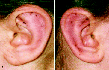 Ohrmuschelkorrektur ohne Hautschnitt – die Fadenmethode von Merck |  SpringerLink
