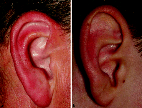 Anatomie und Pathologie der Ohrmuschel | SpringerLink