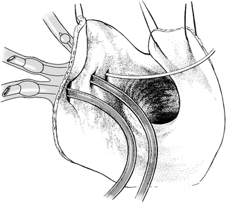 Dilator anwendung