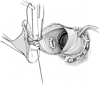 Anwendung dilator Die Harnröhre