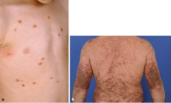 Nävi und benigne Hauttumoren | SpringerLink