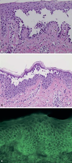 Autoimmundermatosen Springerlink