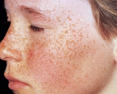 Gewebs- und regionsspezifische Krankheiten der Haut | SpringerLink