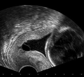 Ultraschallbild 6 Ssw Eineiige Zwillinge