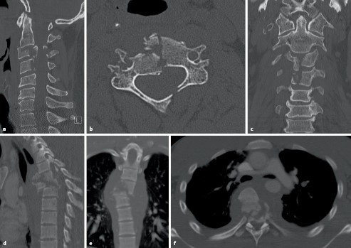 Stammverletzung Wirbelsaule Springerlink