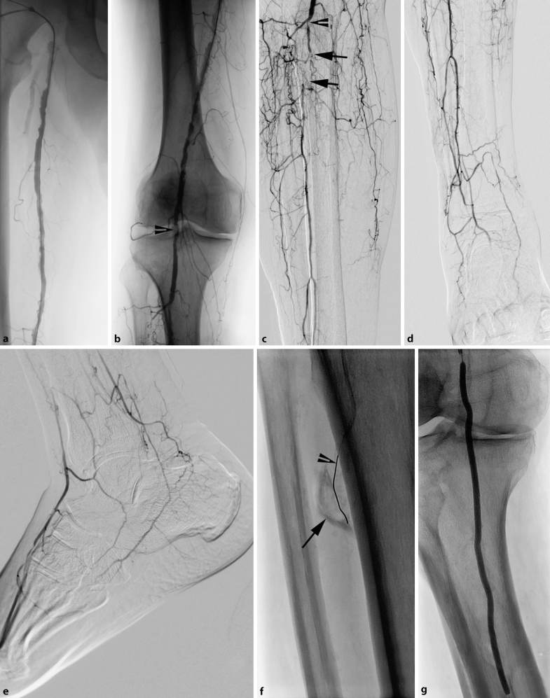 Arterielle Interventionen Springerlink