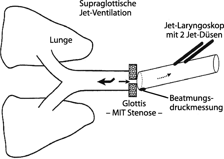 Jetventilation Beim Schwierigen Atemweg Springerlink