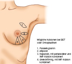 Onkoplastische Chirurgie Springerlink