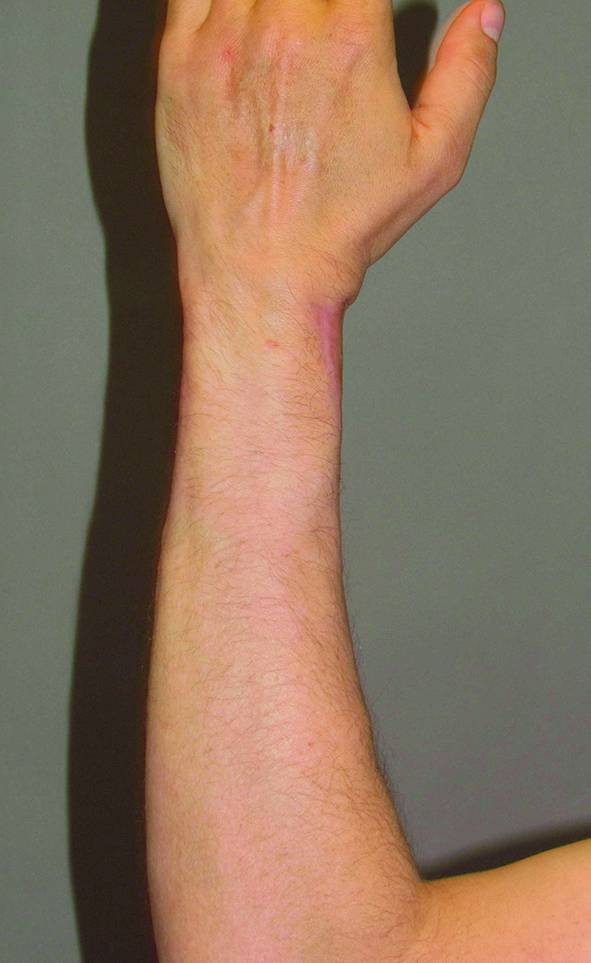 Ergebnis penoidaufbau