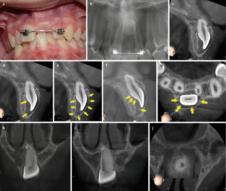 Digitale Volumentomographie Zur Diagnostik Bei Tumoren Springerlink