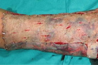 Necrotic Complications After Skin Grafts Springerlink