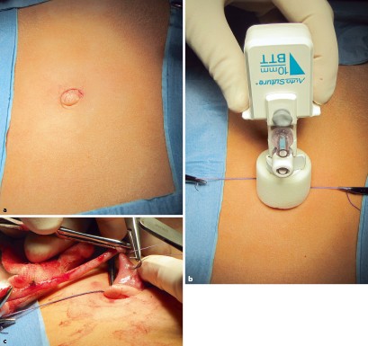 Akutes Abdomen Bei Kindern Springerlink
