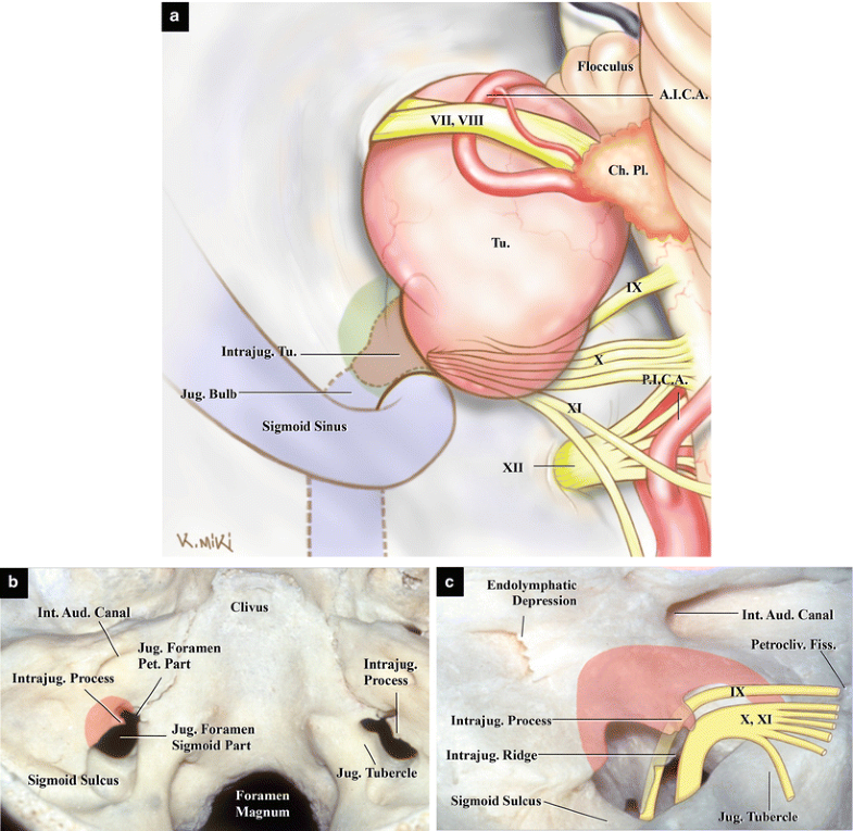 Microsurgical Anatomy of and Surgical Approaches to the Jugular Foramen