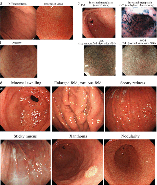 Endoscopic Findings Of H Pylori Infection Springerlink
