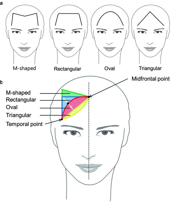 Hair Transplantation For Female Hairline In Asian Women Springerlink