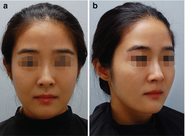 Hair Transplantation For Female Hairline In Asian Women Springerlink