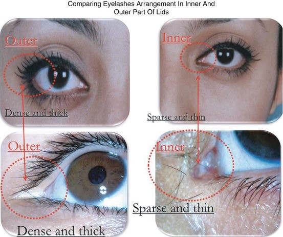 Eyelash Transplantation Springerlink