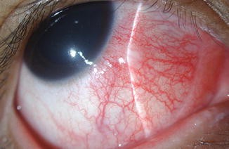 Scleritis Scleritis
