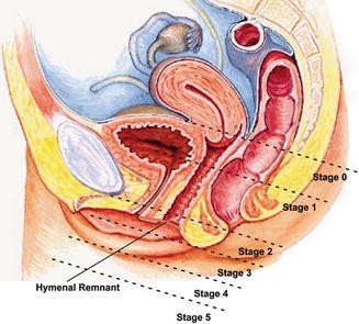 Pelvic Floor Dysfunction Springerlink