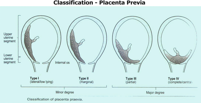 The Lower Segment of Uterus A Critical Area in