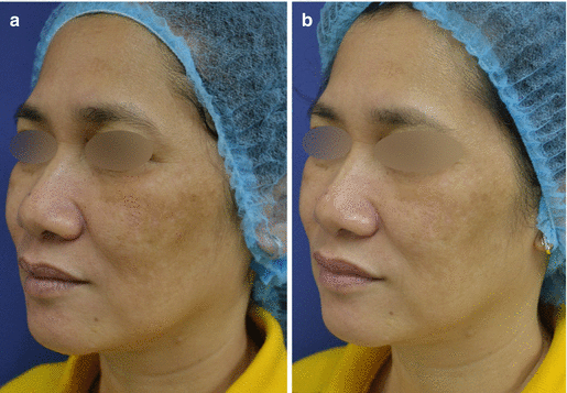Chemical Peeling For Melasma Springerlink Chemical Peeling For Melasma Springerlink