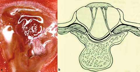 myelomeningocele primary repair surgical technique springerlink myelomeningocele repair