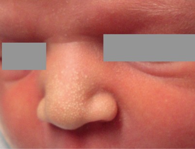 Neonatal Skin Disorders Springerlink