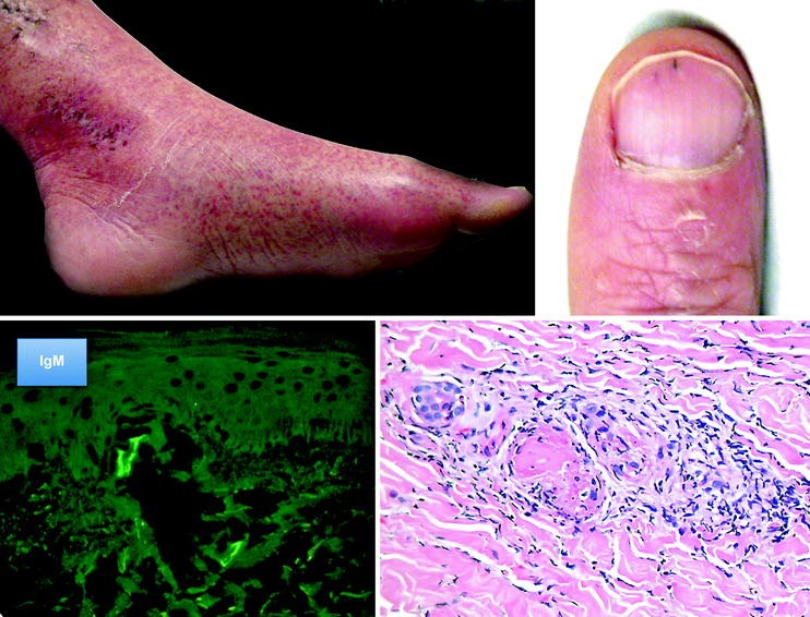 Cutaneous Cryoglobulinemic Vasculitis SpringerLink