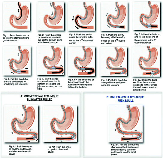 SingleBalloon Enteroscopy SpringerLink