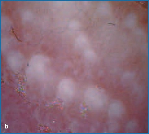 Papules pink pearly Pearly Penile