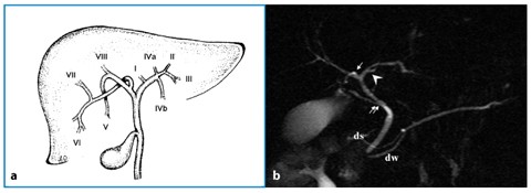 Normal Anatomy Of The Biliary Tree Gallbladder And Pancreatic Duct Springerlink