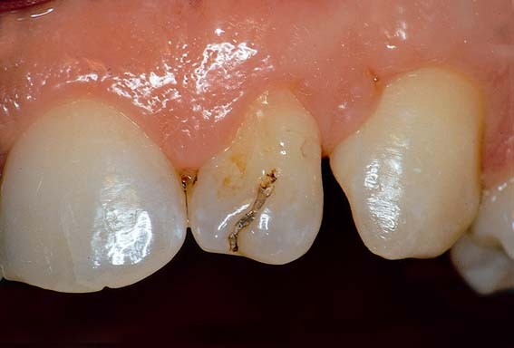 4 Oorzaken Van Tandverkleuringen Springerlink