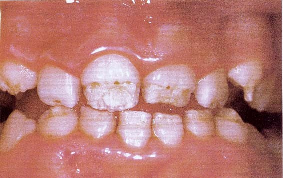 4 Oorzaken Van Tandverkleuringen Springerlink