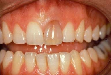 Vulling op voortand valt steeds uit