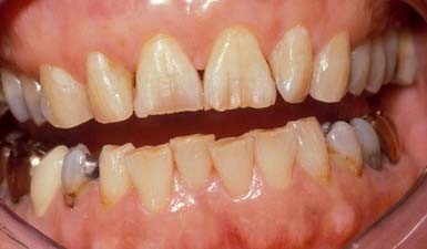 Mijn tanden vallen uit elkaar