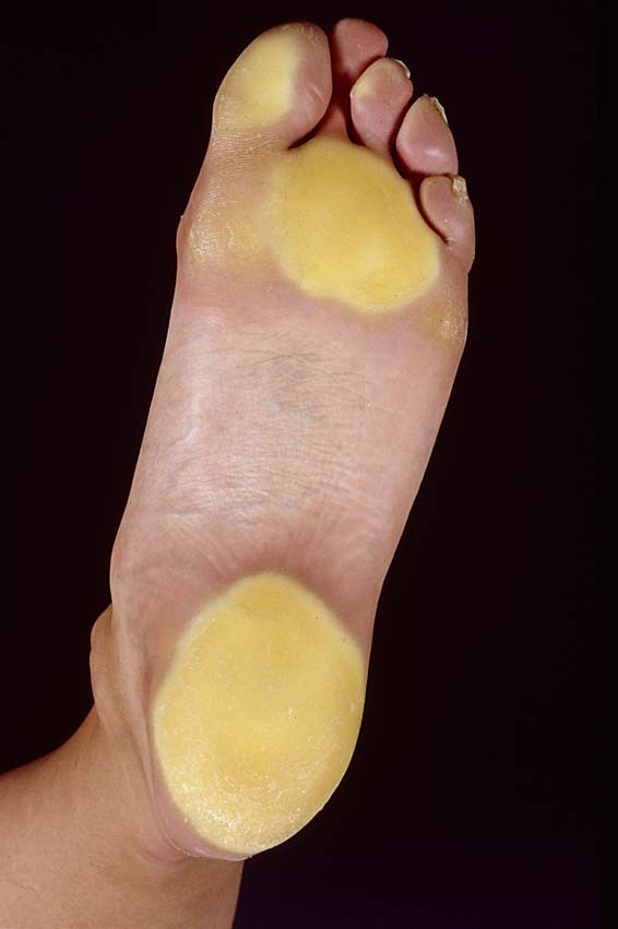 Huidafwijkingen Aan De Voeten Springerlink