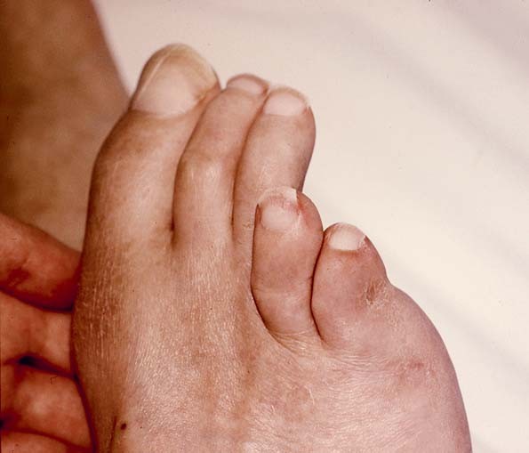 Huidafwijkingen Aan De Voeten Springerlink