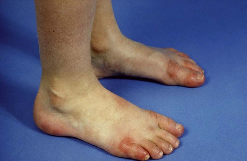 Huidafwijkingen Aan De Voeten Springerlink