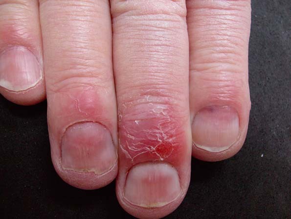 Huidafwijkingen Aan De Voeten Springerlink