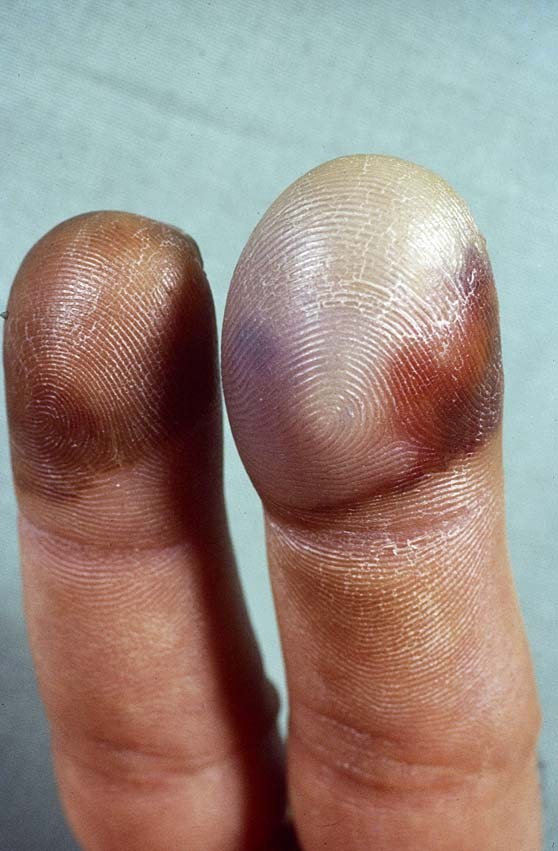 Huidafwijkingen Aan De Voeten Springerlink